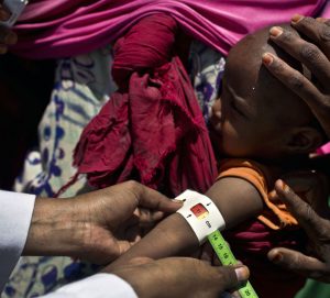 acute malnutrition in somalia